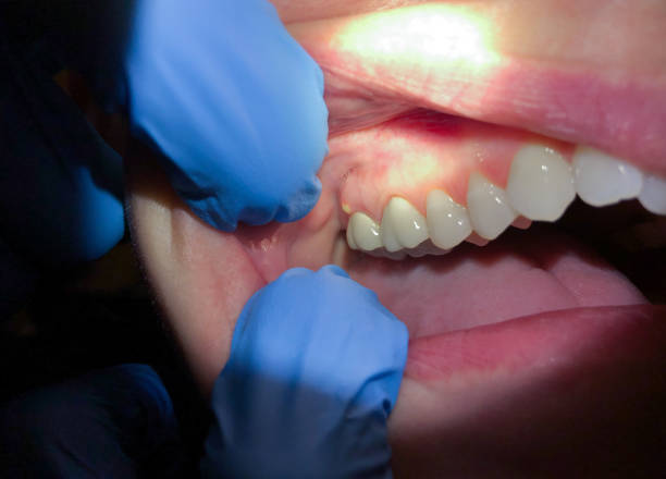 Best Emergency Dental Care for Broken or Chipped Teeth in De Queen, AR